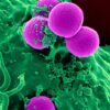 sickle cell