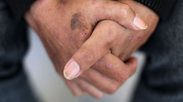 Around 1.1 million people are living with HIV