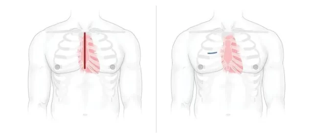 Traditional heart surgery