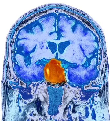 A pituitary adenoma