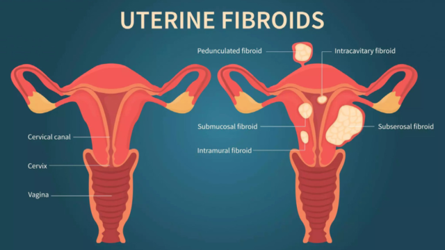 Healthy uterus v. fibroids