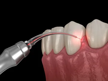 Laser light energy heats the affected gum tissue.