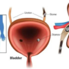 Kidney stones