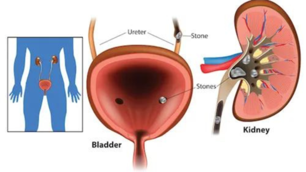 Kidney stones